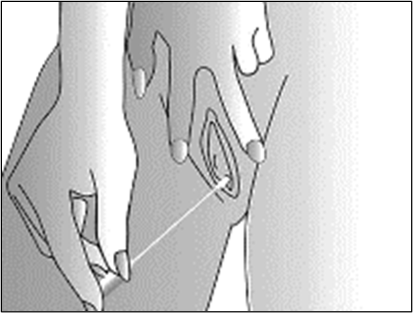 把拭子從袋子中取出,再把拭子放進陰道內。